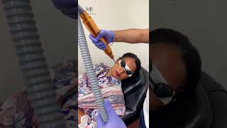 Pico Laser by Dr Rizwan Malik  MR Aesthetics Lahore  Dr Rizwan Malik  youtubeshorts trending [upl. by Aznaed]