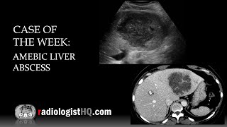 Case of the Week Amebic Liver Abscess Ultrasound amp CT [upl. by Annuahs]