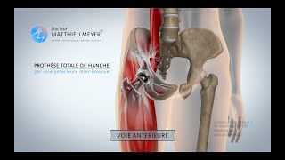 PROTHÈSE TOTALE DE HANCHE PAR VOIE ANTÉRIEURE MINIINVASIVE  DR MATTHIEU MEYER [upl. by Awuhsoj]