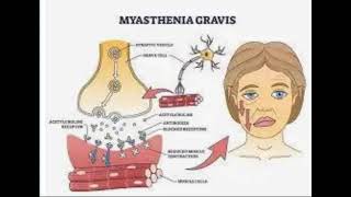 Myasthenia Gravis [upl. by Gaw]