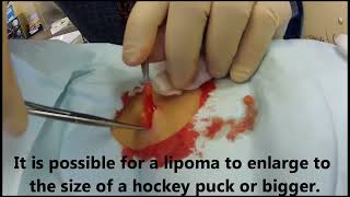 Office Procedure Lipoma Removal [upl. by Gaivn]