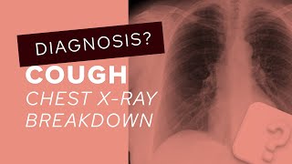 Chest XRay breakdown looking for difficult lung nodules [upl. by Etyam]