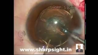 Cionni ring placement for subluxated cataract at sharp sight [upl. by Ahsar395]