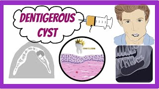 ORAL PATHOLOGY  DENTIGEROUS CYST [upl. by Assirehs]