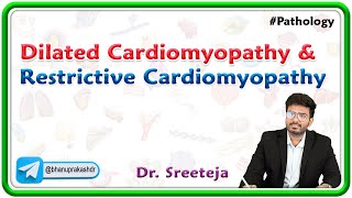 10 Dilated Cardiomyopathy and Restrictive Cardiomyopathy  Pathology USMLE Step 1 [upl. by Irolav]