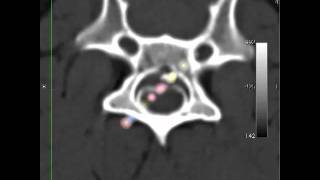 veterinary CT pet animal dog myelography [upl. by Allison408]