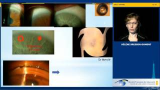Fermeture de l’angle et cristallin  Je la traite uniquement par iridotomie Hélène BressonDumont [upl. by Chelsy162]