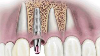 Duelen los Implantes Dentales [upl. by Goss]