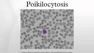 Poikilocytosis [upl. by Lupee]