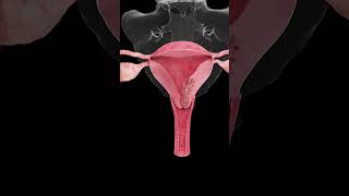 🎗️ Understanding Endometrial Cancer A Growing Concern for Women’s Health 🎗️ [upl. by Eimmac320]