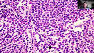 Tip55 Undifferentiated Endometrial Carcinoma [upl. by Tsai]