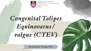 LESSON 8 CONGENITAL TALIPES EQUINOVARUSVALGUS CTEV [upl. by Eneleahs815]