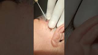 Electrocoagulation of Soft Fibroma on the Scalp [upl. by Nanyk]