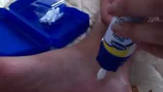 Dr Scholls Dual Action Freeze away wart remover how to for large warts [upl. by Lach]