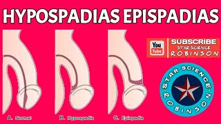 HYPOSPADIAS EPISPADIAS IN STAR SCIENCE ROBINSON [upl. by Margalit]