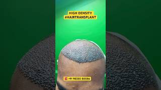 Hair Loss Treatment hair hairloss hairlosstreatment ytshorts alopecia hairtransplant hairfall [upl. by Dong]