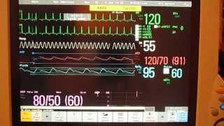 MP70 Demo Adult Neonatal [upl. by Tracey]