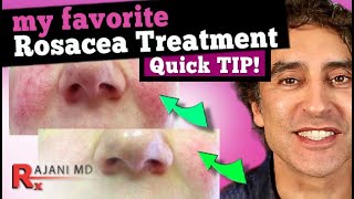 FACE FLUSHING TREATMENT  MY FAVORITE ROSACEA TREATMENT  Rosacea Cure [upl. by Calloway346]