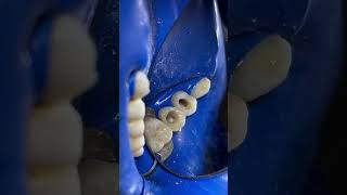 thedentalviews dentalprocedure dentalpractice dentaltreatment [upl. by Nelson341]