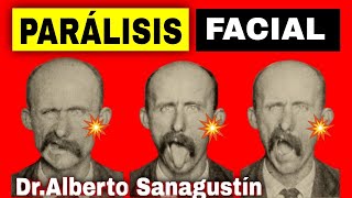 PARÁLISIS FACIAL 💥 Síntomas Causas y Tratamiento [upl. by Stoneman]