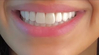 ღ your teeth are literally perfect  veneers procedure 💉 [upl. by Arman]