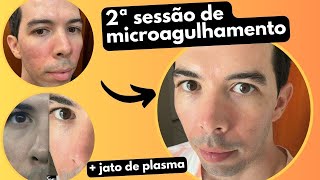 MICROAGULHAMENTO E JATO DE PLASMA 2ª Sessão [upl. by Aillimac]