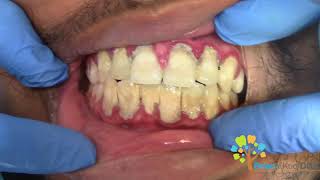 Dental Cleaning to remove heavy tartar🦷 【Young Male first cleaning】 [upl. by Nywg]