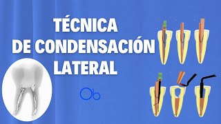 Ténica de Condensación lateral 🦷 en Endodoncia [upl. by Danica]