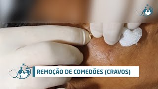 Comedão Comedone  Ep 03 vídeo rápido  extração de cravos [upl. by Risay]