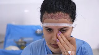 Female Hairline Lowering Hair Transplant  Surgical Hairline Advancement [upl. by Jamaal]