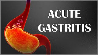 Acute Gastritis  Signs amp Symptoms Causes Pathogenesis Complications Diagnosis amp Treatment [upl. by Neelahtak]