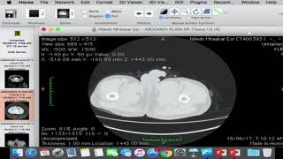 Planning surgery for acetabular fracture using HOROS [upl. by Alleen]