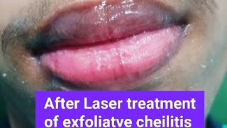 Two cases of exfoliatve cheilitis treated by Laser excellent response [upl. by Isied]