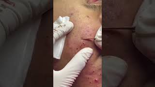 Best Pimple Popping 07 beautiful blackheads sacdepspa [upl. by Fidela]