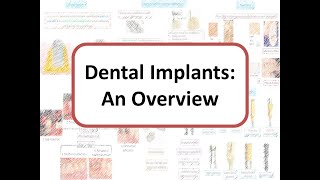 Implants An Overview Osseointegration Types of Bone One stage vs Two stage surgery [upl. by Elyc]