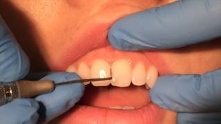 Periodontal Probing [upl. by Thordia]