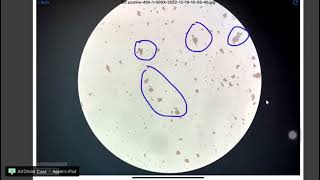 Direct coombs test positive test under microscope [upl. by Oht]