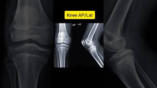 X ray Knee APLat [upl. by Ifill]