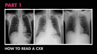 Anatomy of a Chest XRay  How to Read a Chest XRay Part 1 [upl. by Nicky757]