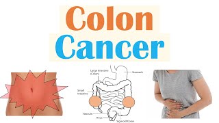 Colon Cancer CRC Risk Factors Pathogenesis Symptoms Diagnosis Staging Treatment [upl. by Marcel]