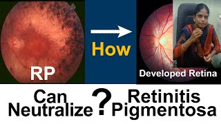 Retinitis Pigmentosa  How she got useful vision  Medical Improvement  DrSasi [upl. by Haelhsa431]