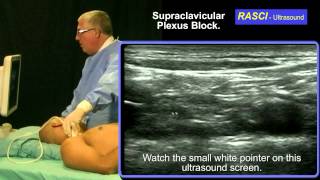 Ultrasound guided Supraclavicular plexus block [upl. by Willem]