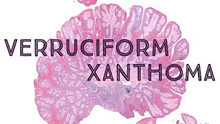 Verruciform xanthoma  clinical mimic of condyloma AIP France 2021  Case 7 [upl. by Lawlor]