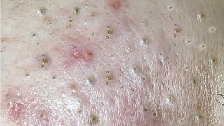 Nasa SPA 2021  Satisfying blackhead Acne Relaxing [upl. by Yalc]