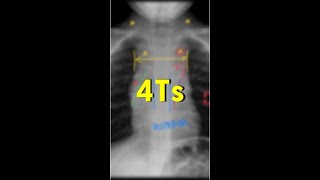 4Ts do mediastino anterior [upl. by Eirojam996]