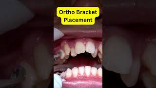 Braces Installation REVEALED Step by Step [upl. by Elmo]