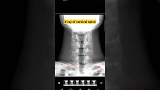 Xray of cervical region  Exam QA [upl. by Leima765]