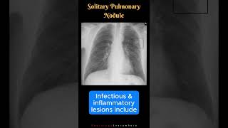 Solitary Pulmonary Nodules Mass like Lesions Differential Diagnosis shorts [upl. by Gnouv]