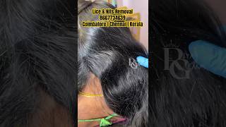 Lice removallice treatment parlour Chennailice removal for long hairhow to remove lice from hair [upl. by Daryn]