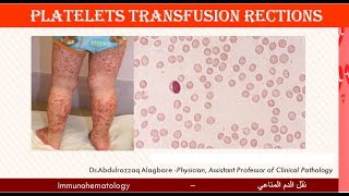 Lecture 218 Platelets Transfusion Reactions [upl. by Letitia]